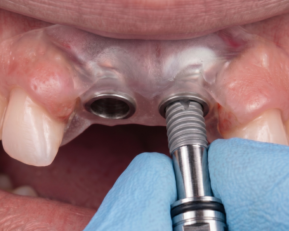 implante-dental-lima