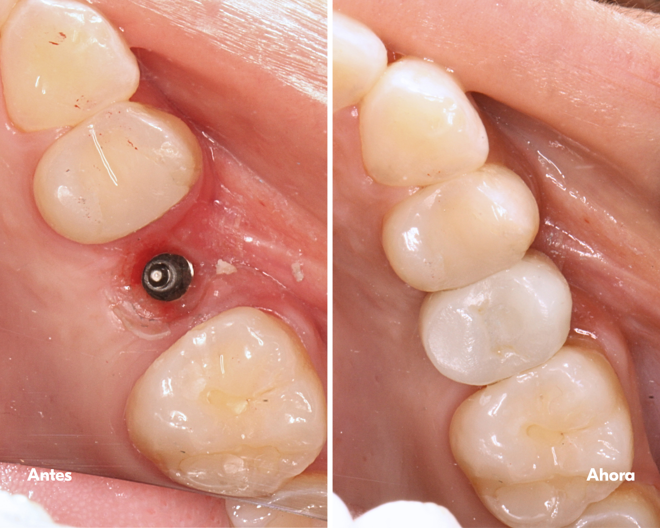 casos-antes y después-implante-dental