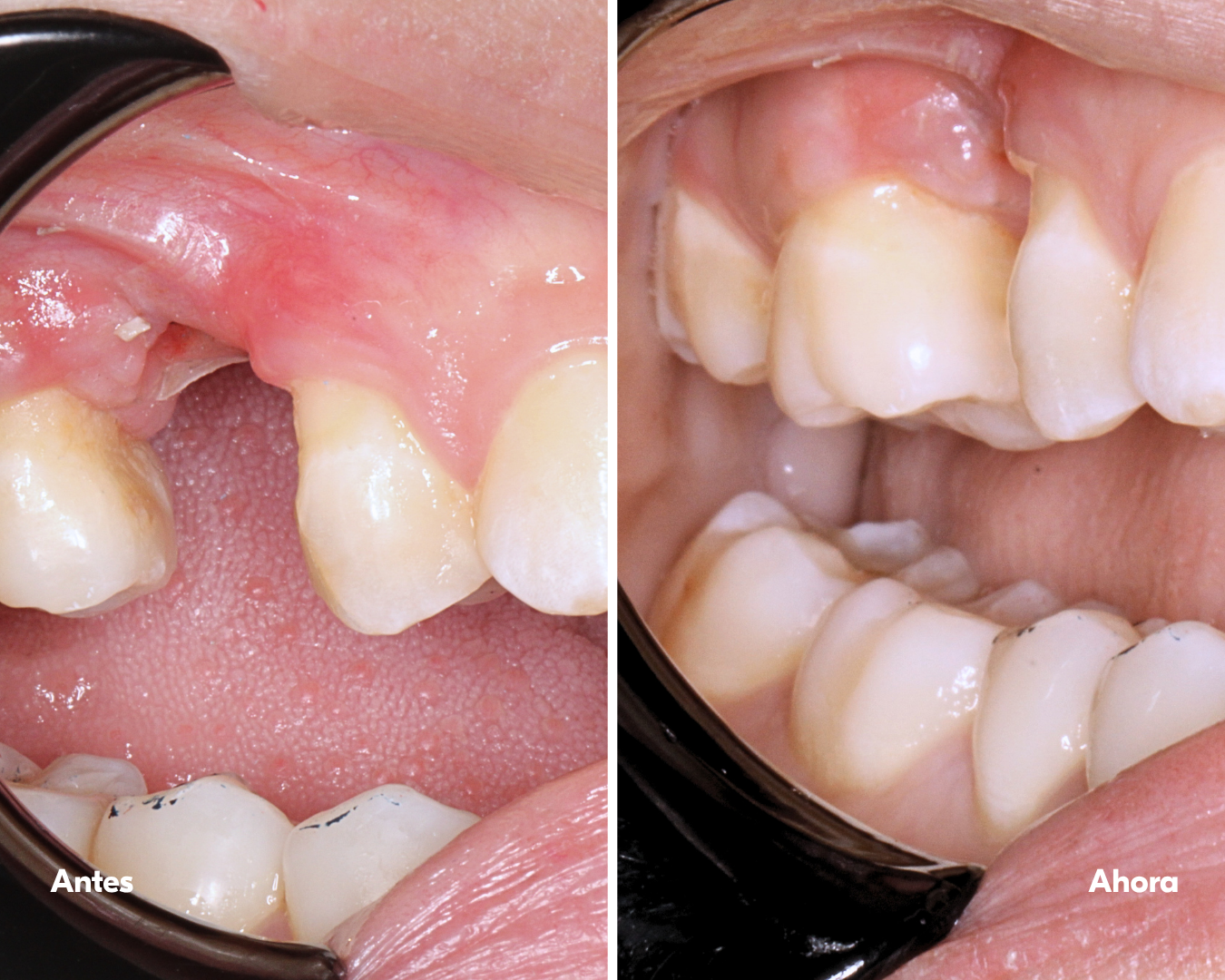 all on x - implantes-dentales-lima-antes y después