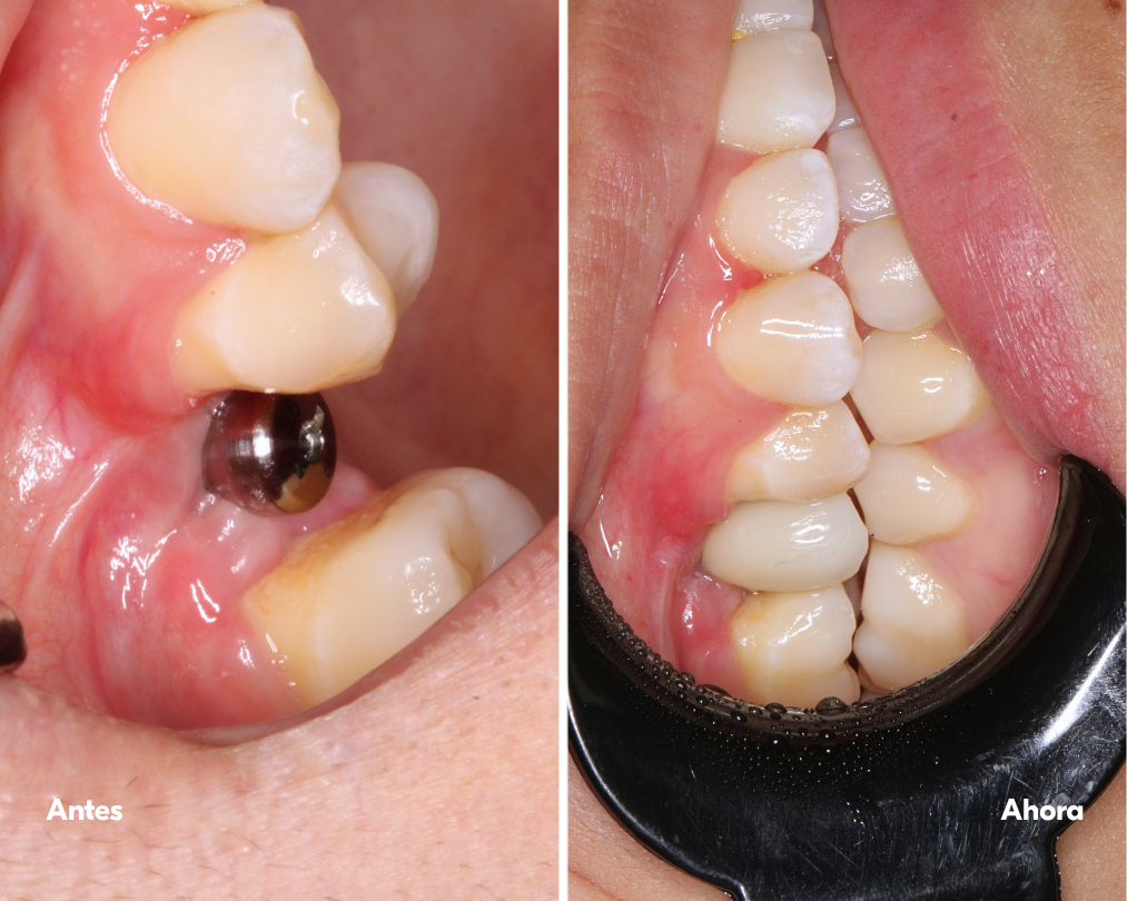 all on x - implantes-dentales-lima-antes y después