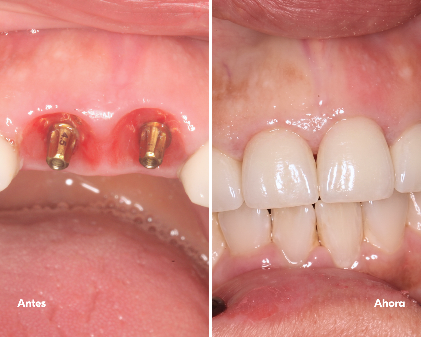 all on x - implantes-dentales-lima-antes y después