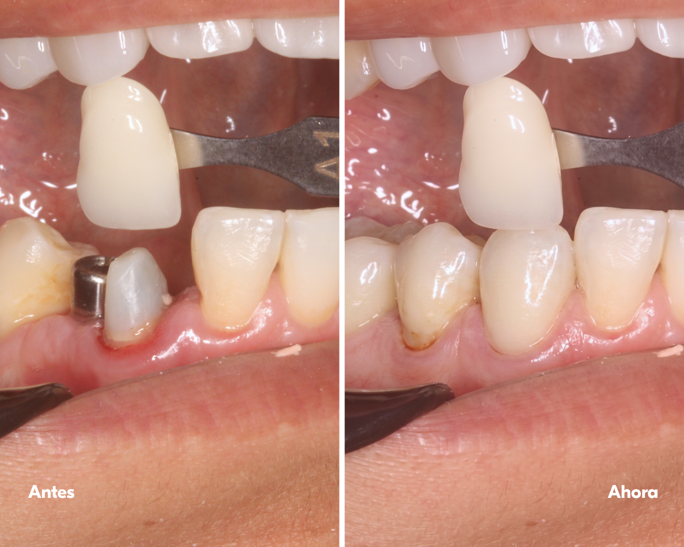 all on x - implantes-dentales-lima-antes y después