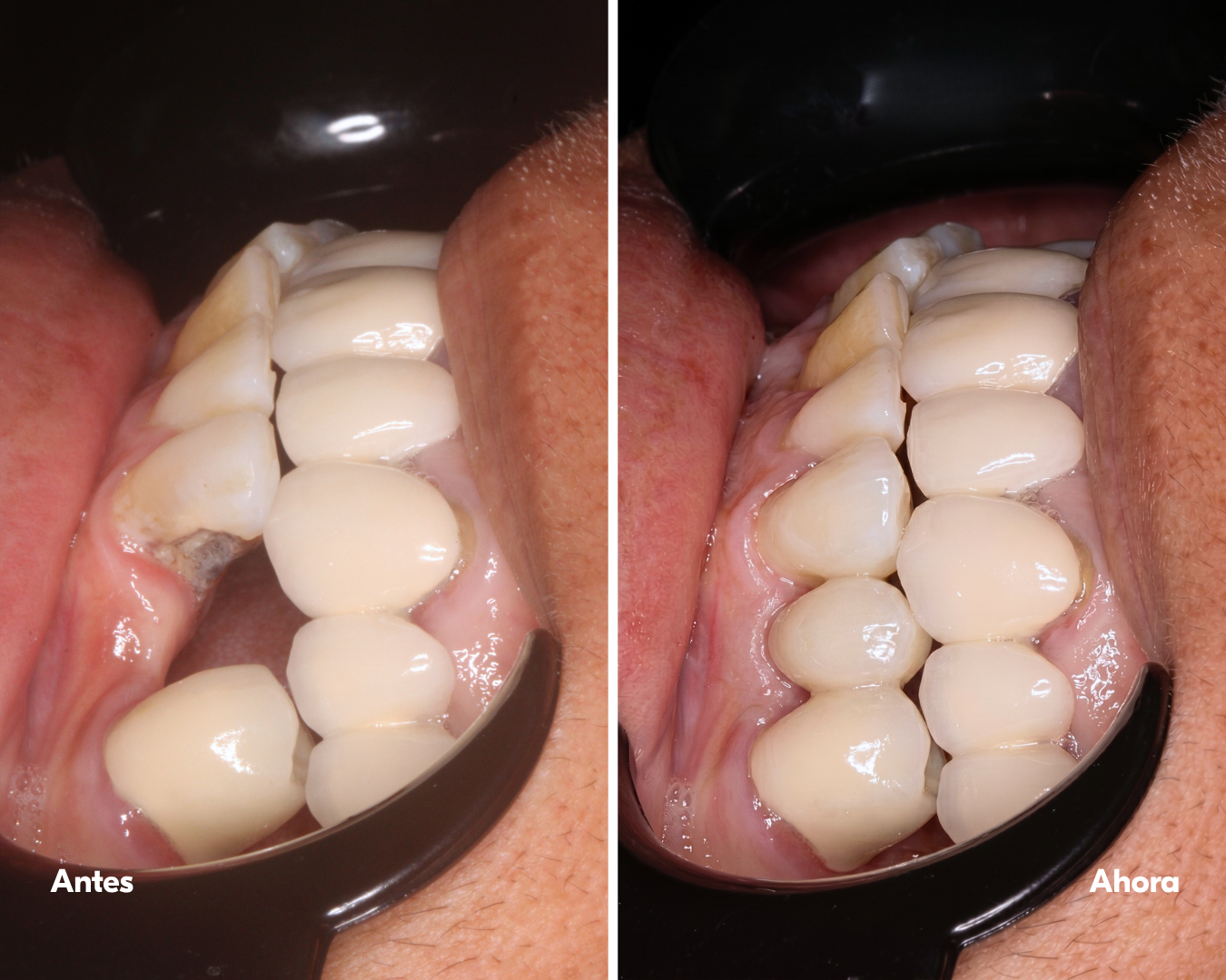 all on x - implantes-dentales-lima-antes y después