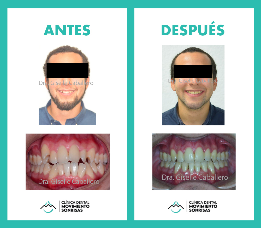 Caso-de-éxito_diseño-de-sonrisa_Movimiento-Sonrisas