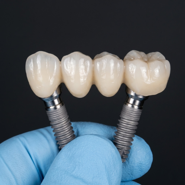 implante-dental-movimiento-sonrisas