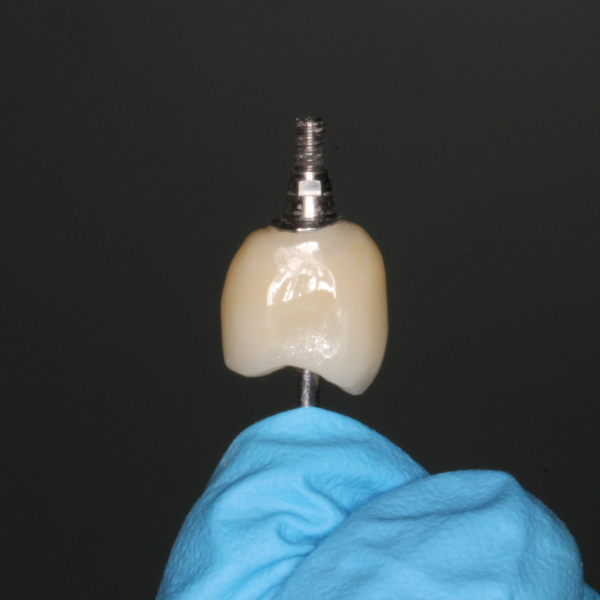 Implante-Dental-Unitario