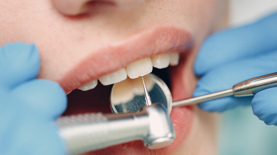 limpieza-dental-dentista-miraflores-lima