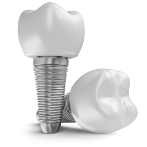 implante-dental-movimiento-sonrisas implante-dental-movimiento-sonrisas
