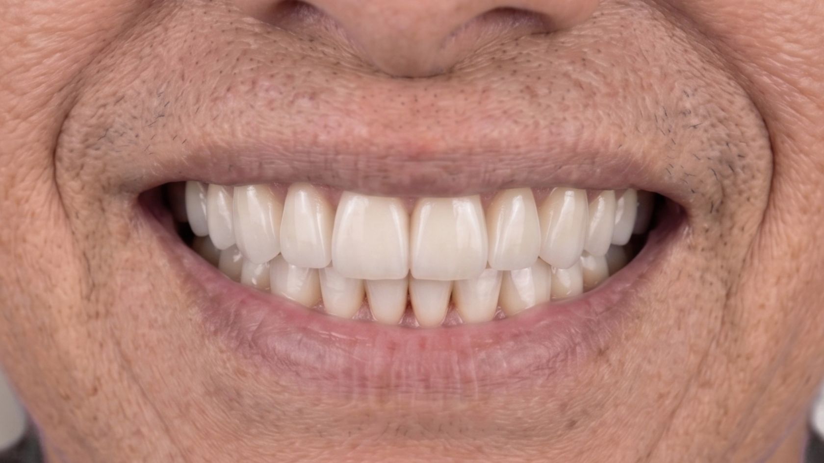 implante-dental-lima