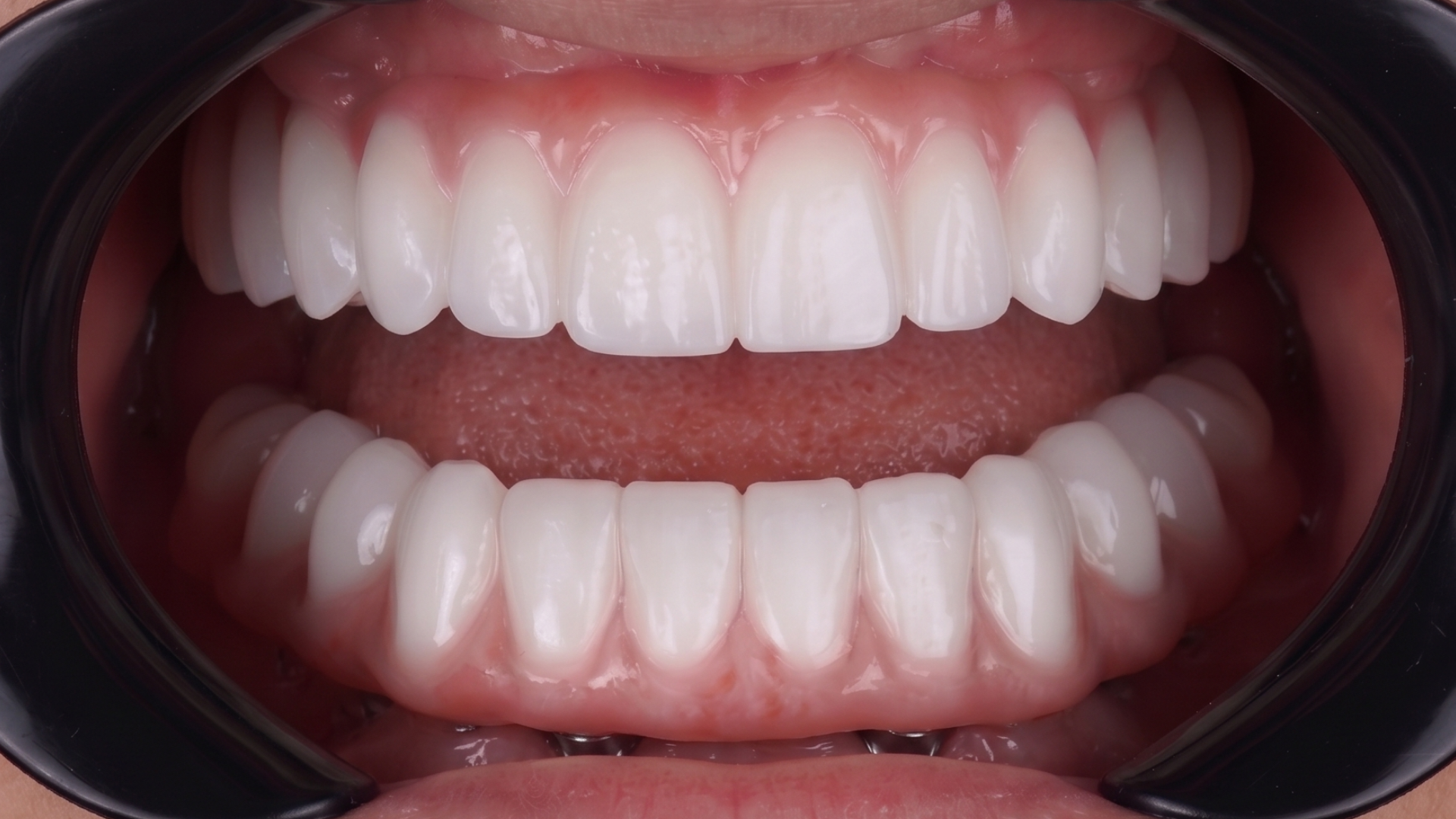 all on x - implantes-dentales-lima-antes y después