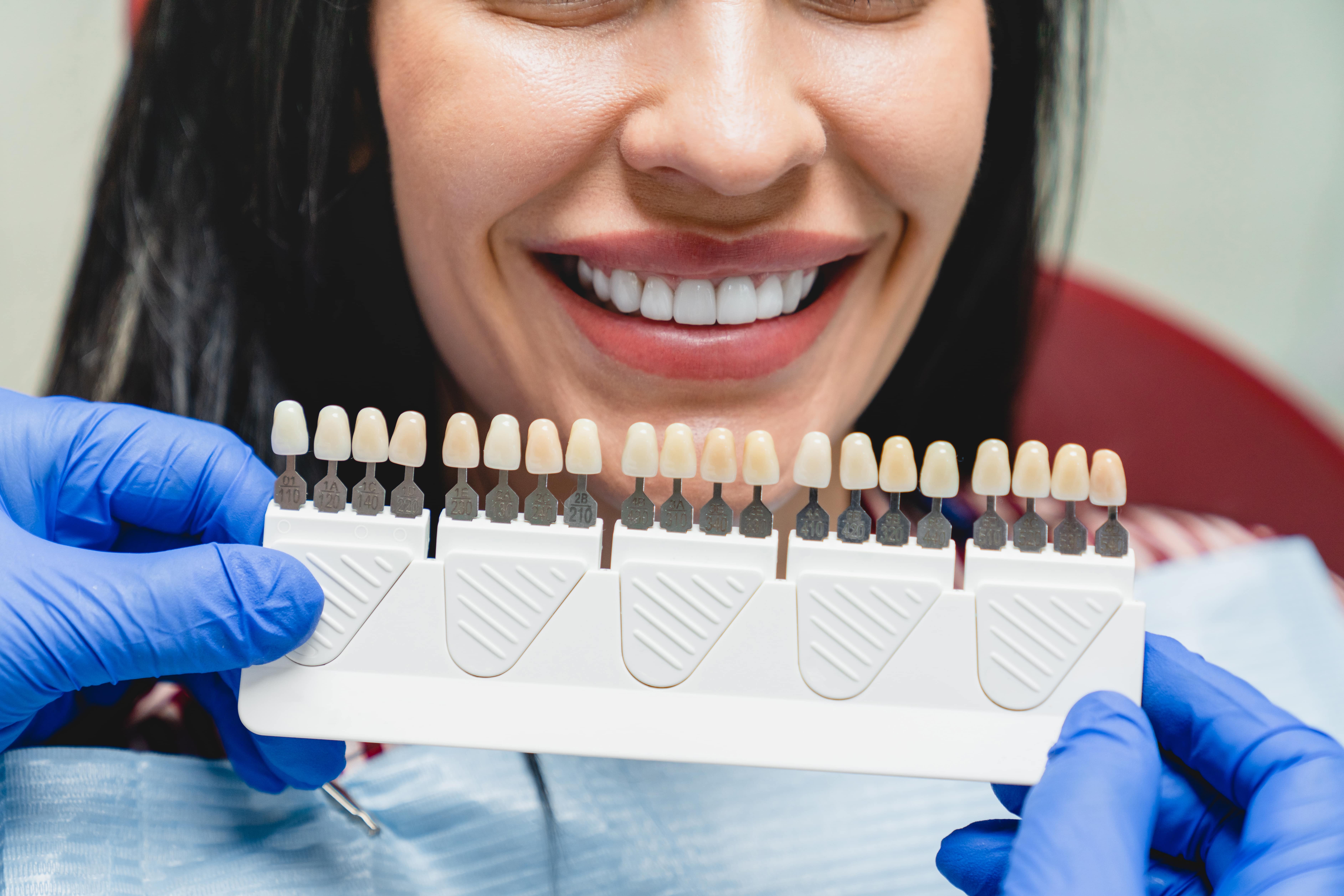 whitening-concept-dental-care-implants-veneers-2021-12-09-04-23-39-utc-min-1