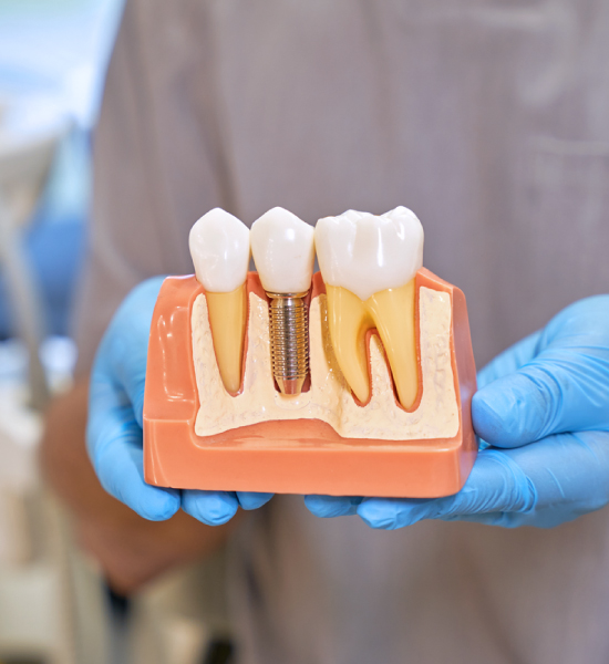 movimientosonrisas-implantes-dentales-(1)