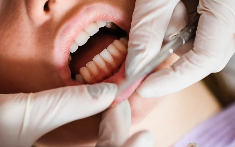 clinica-dental-miraflores-periodoncia-encias