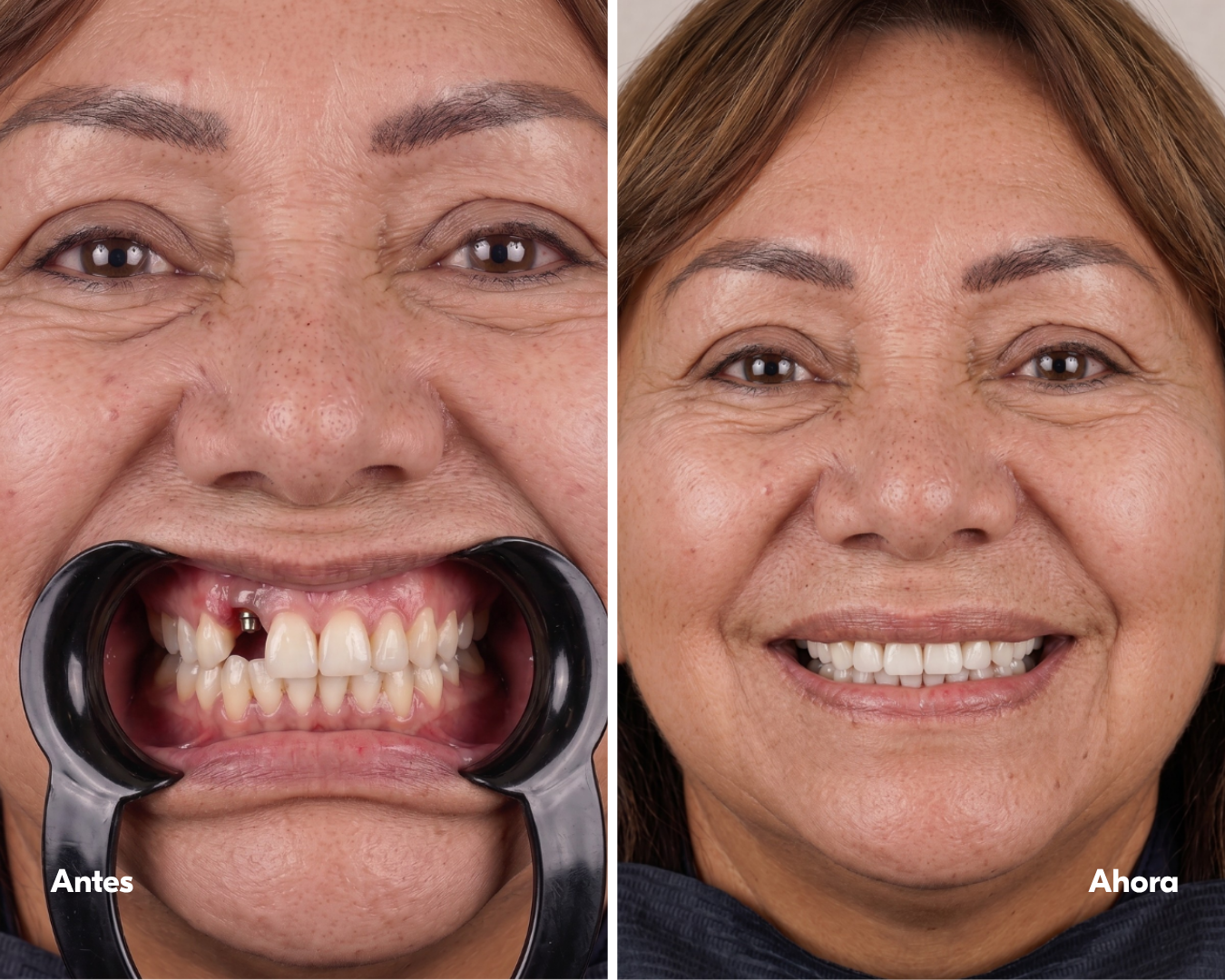 implante-dental-lima-casos