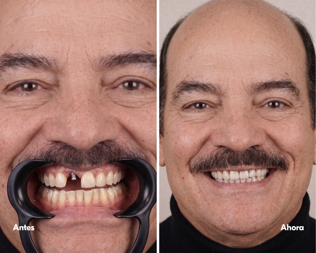implante-dental-lima-casos