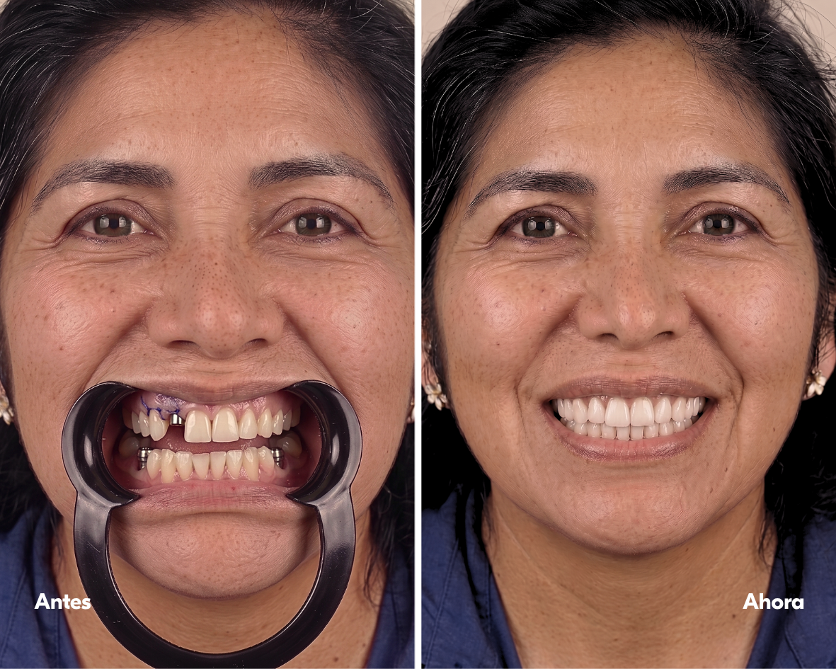 implante-dental-lima-casos