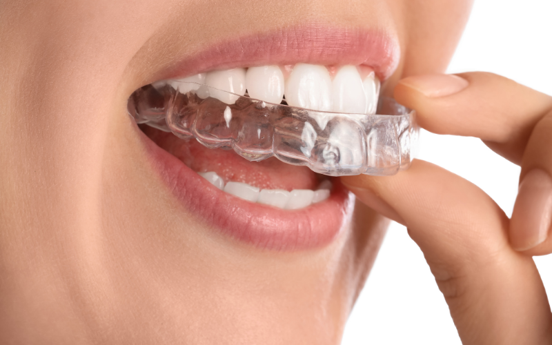 clinica-dental-miraflores-alineadores-invisible