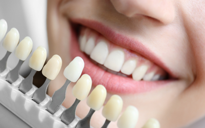 blanqueamiento-dental-miraflores