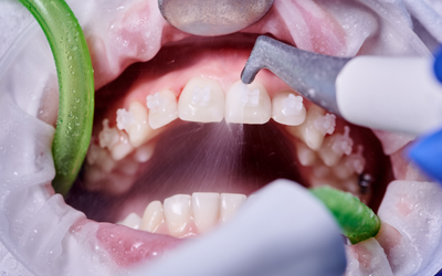 blanqueamiento-dental-miraflores