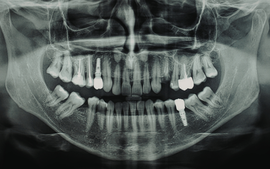 clinica-dental-miraflores-implantes-dentales