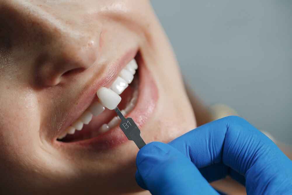 carillas dentales movimiento sonrisas