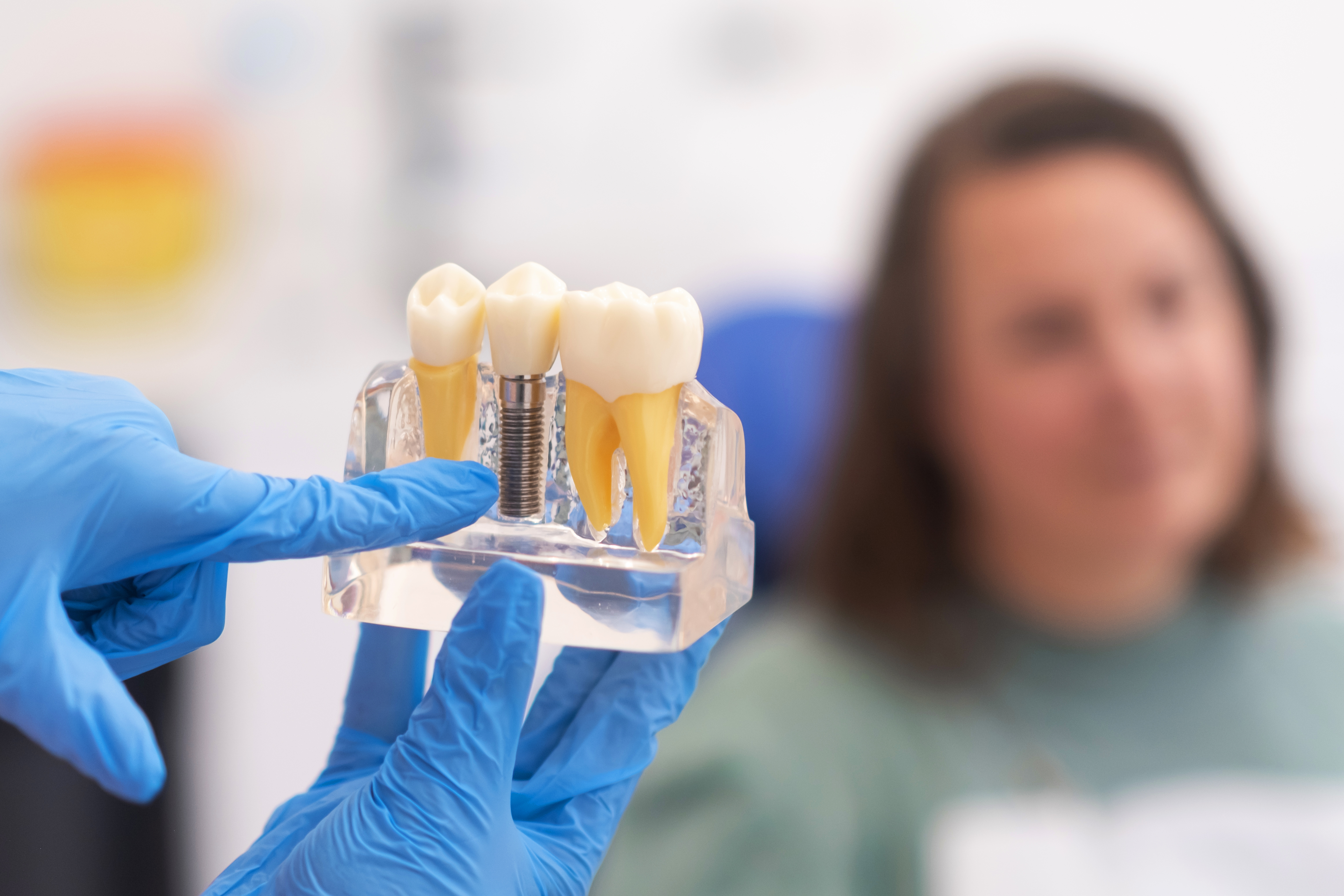 Reemplazo dental estético con corona sobre implante en Lima — Movimiento Sonrisas.