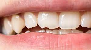 desgaste del esmalte, desgaste dental