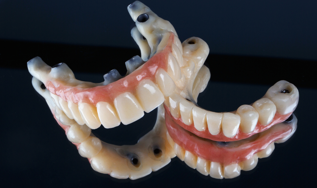 clinica-dental-miraflores-implante-dental-movimiento-sonrisas