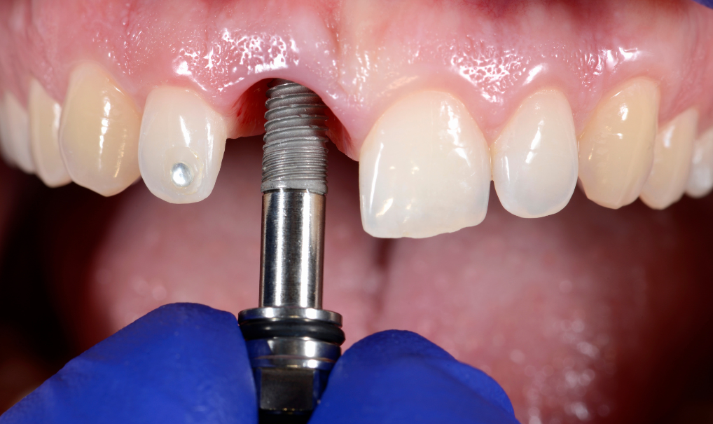 implantes-dentales-lima-peru