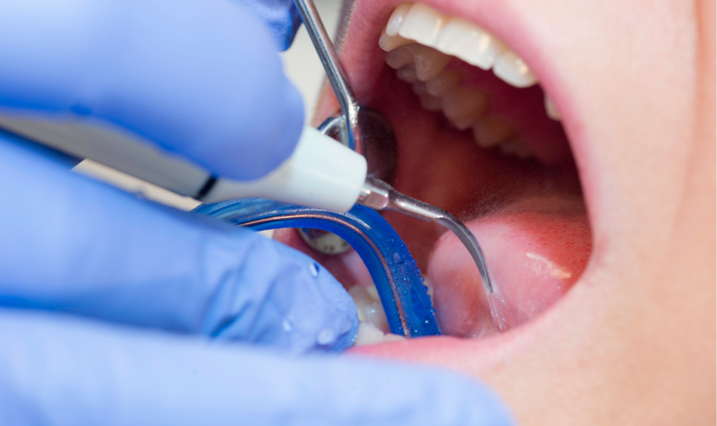 limpieza-dental-miraflores-movimiento-sonrisas