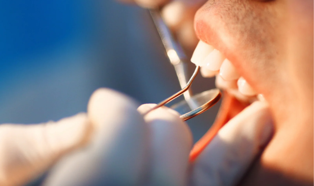 limpieza-dental-miraflores-movimiento-sonrisas