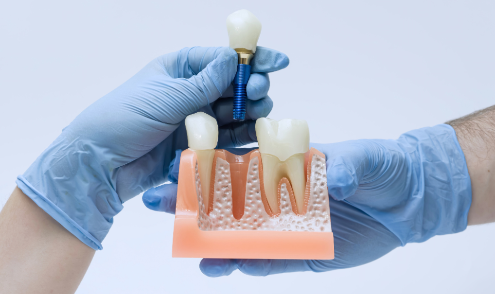 Implantes dentales antes y después: resultados reales en pacientes de Lima