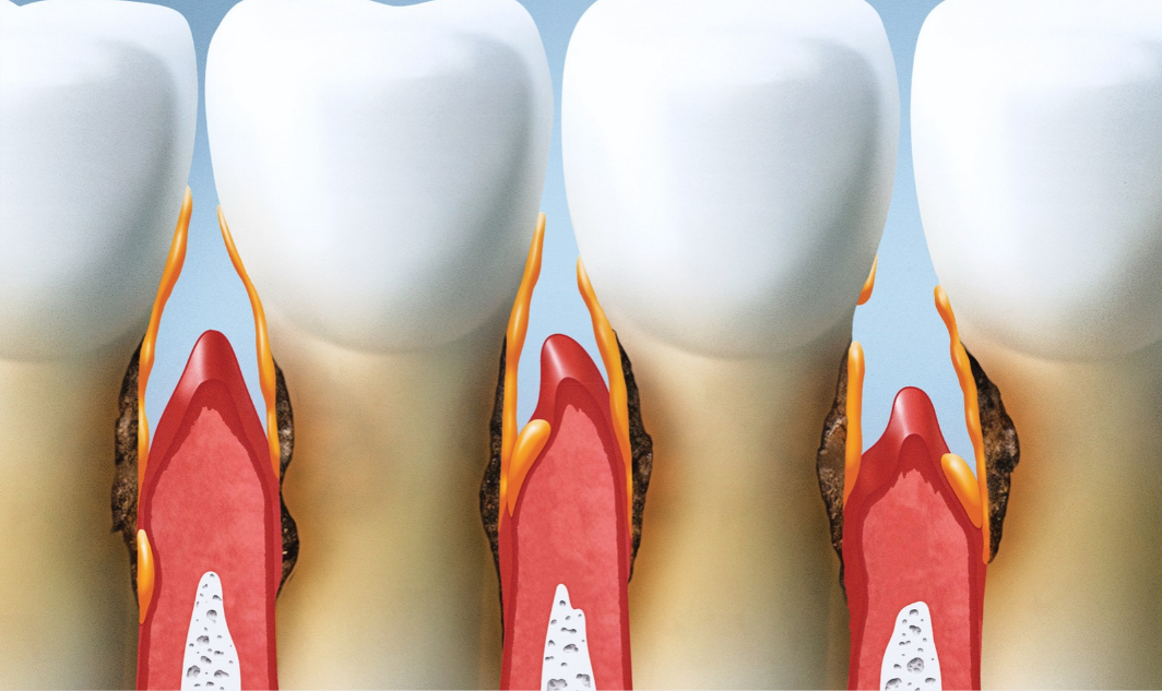 periodoncia-miraflores-movimiento-sonrisas