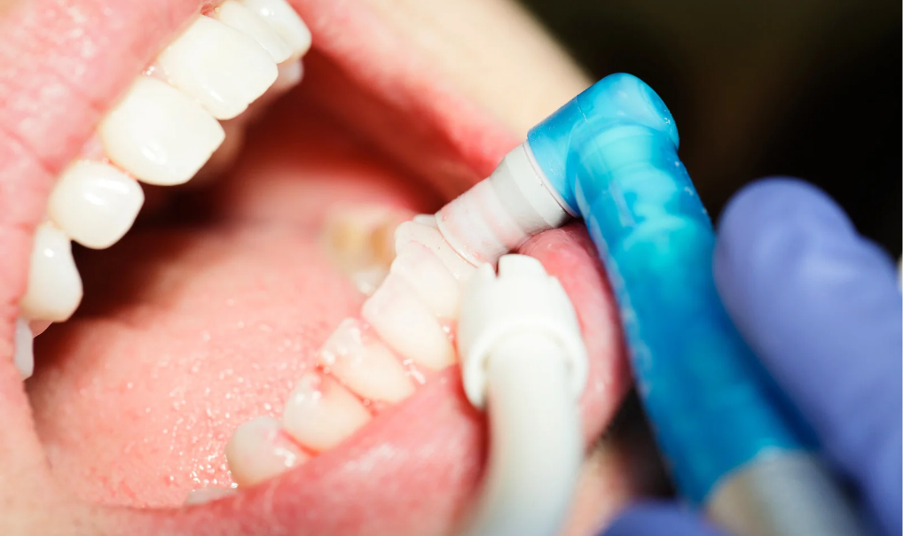 limpieza-dental-miraflores-movimiento-sonrisas