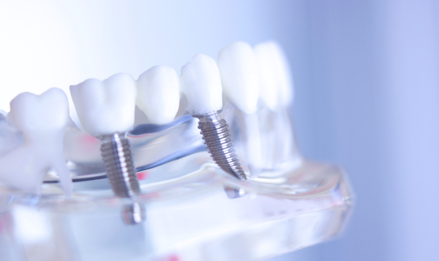clinica-dental-miraflores-implante-dental-movimiento-sonrisas