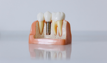 clinica-dental-miraflores-implante-dental-movimiento-sonrisas
