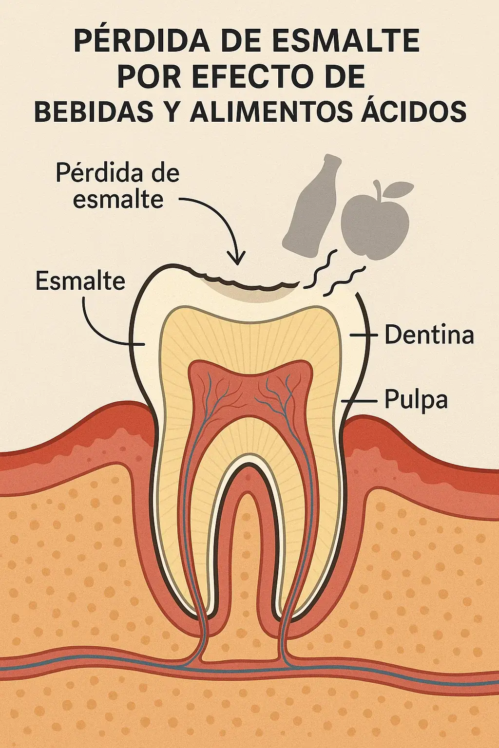 Diagrama de un diente mostrando pérdida de esmalte por efecto de bebidas y alimentos ácidos